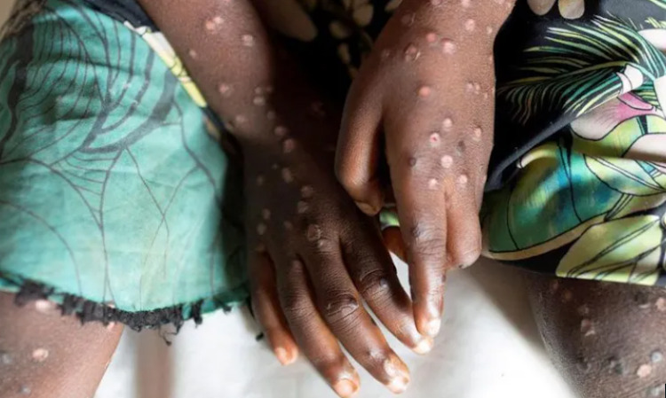 M pox causes flu-like symptoms and a distinctive rash